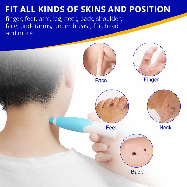 2 in 1 painless auto skin tag mole removal kit