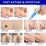 2 in 1 painless auto skin tag mole removal kit